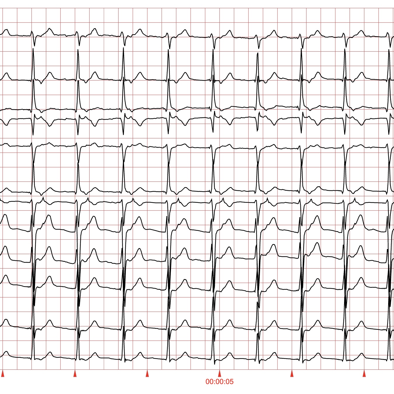 IA ECG